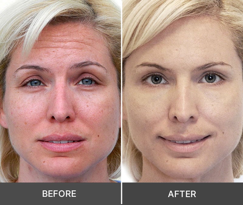 Idrotherapy before and after results